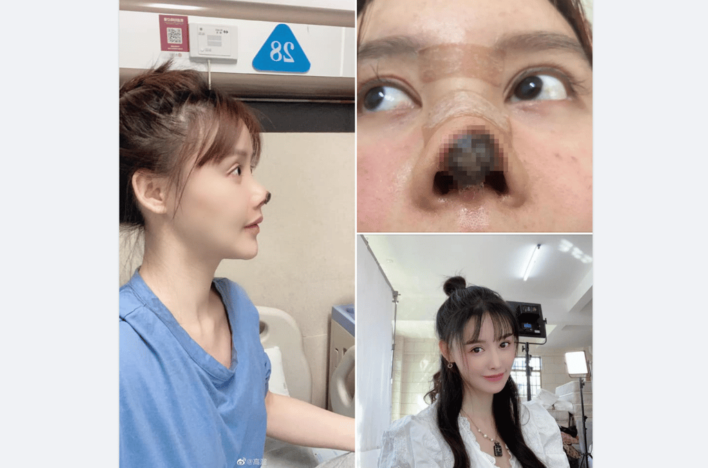 Chinese Actress Shares Photos of Her Botched Nose Surgery Courthouse