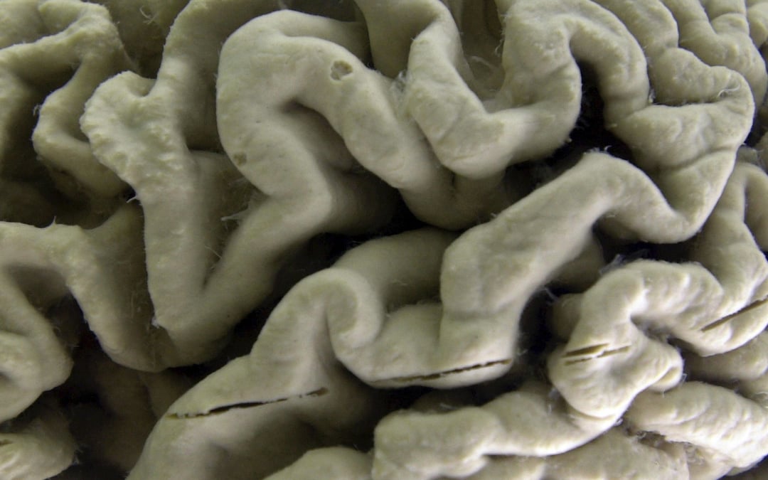 New drug for Alzheimer’s ‘highly promising’ when given early