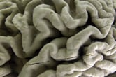 A section of a human brain with Alzheimer's.