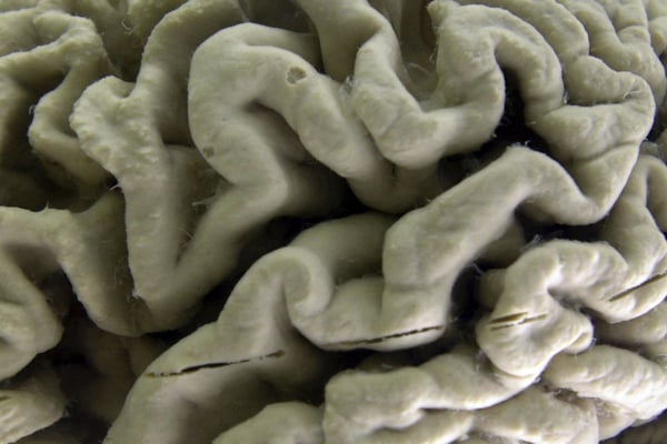 A section of a human brain with Alzheimer's.