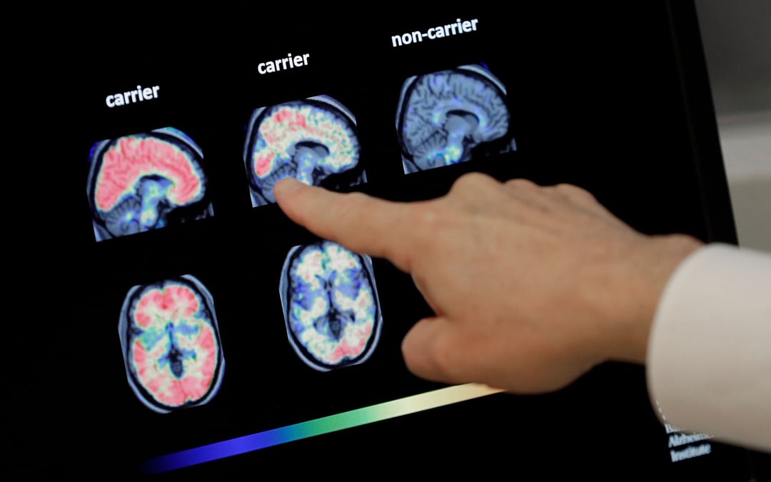 Why can’t Alzheimer’s patients remember? Scientists may have found the answer