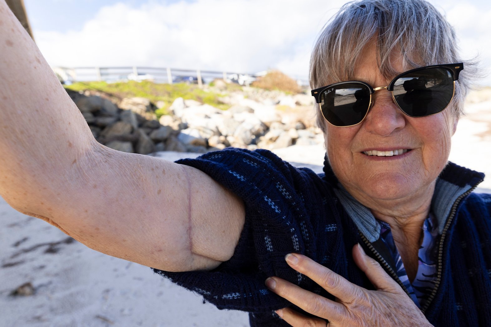 Pam shows the scar where the serrated ray barb had to be surgically removed. Photo: Sia Duff