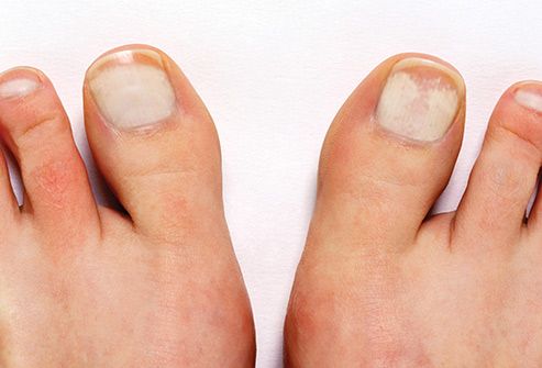 the image shows, white spots on toenails