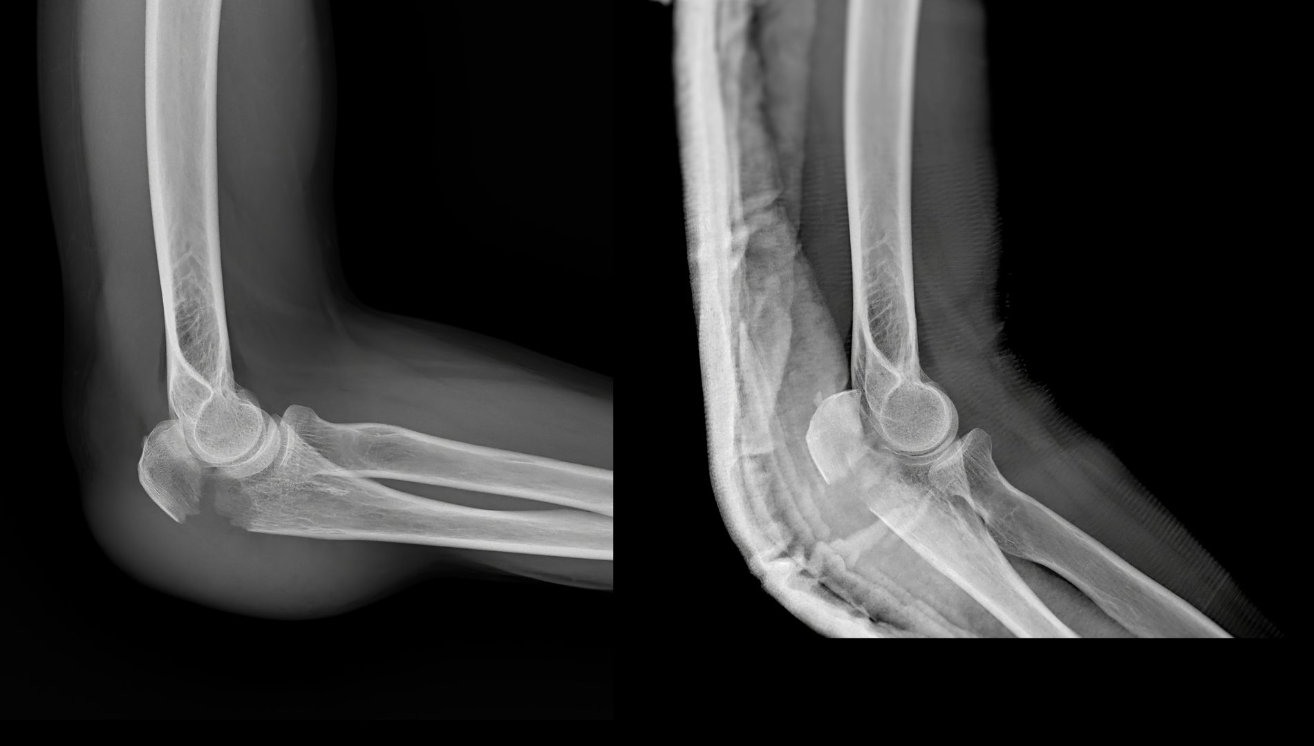 An X-ray image showing a fracture of the olecranon process of the ulna