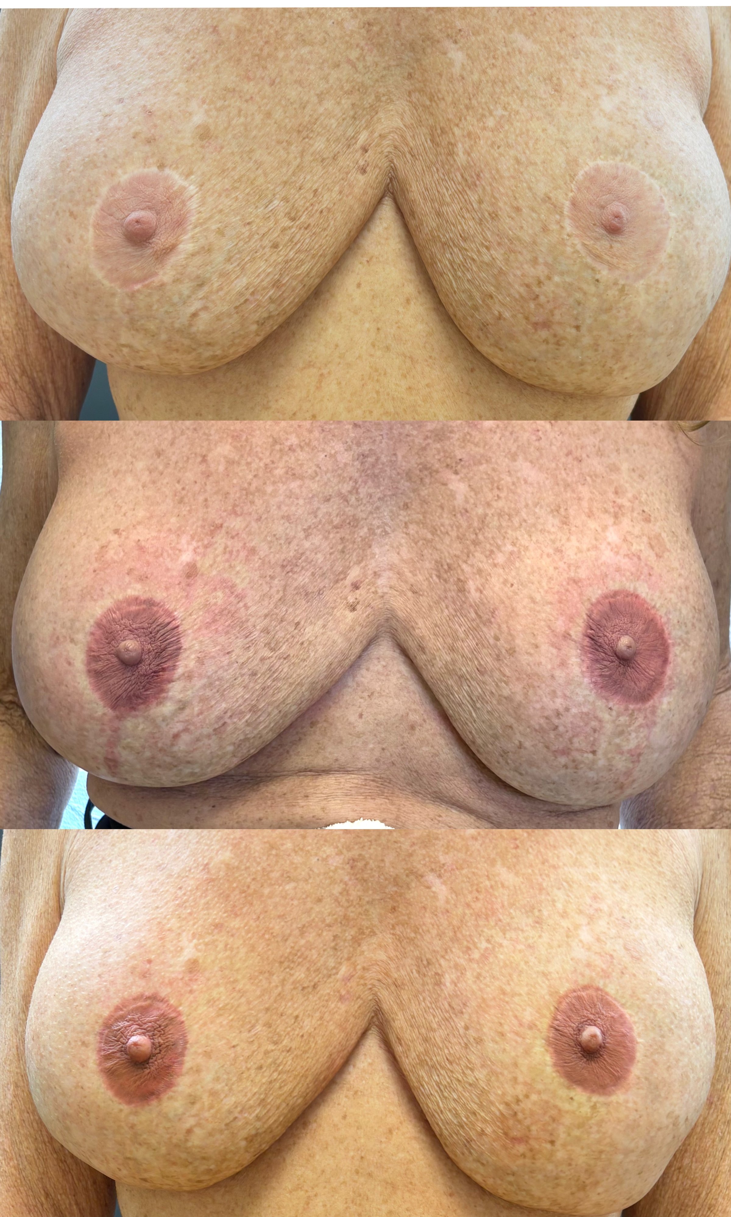 Before and after breast restoration scar camouflage result