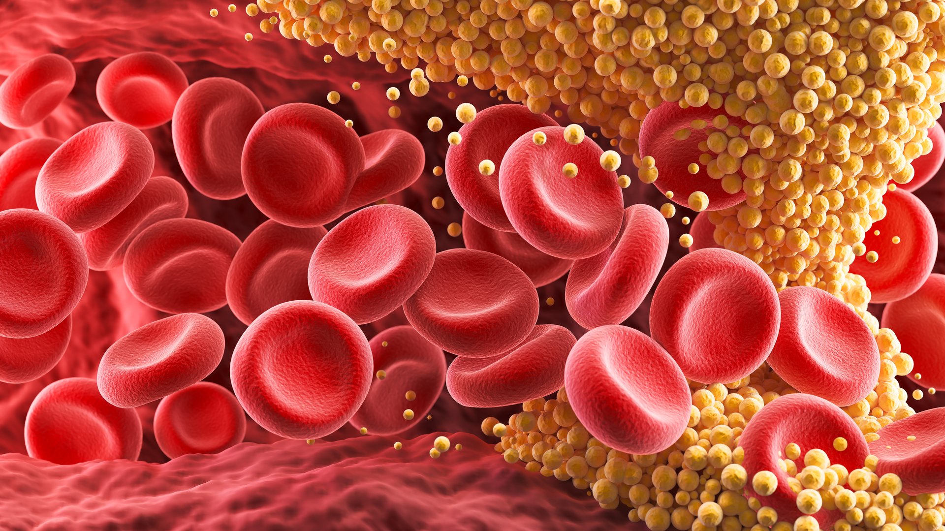 High Blood Cholesterol, Thickened Arteries and Veins, Red Blood Cells, 3d illustration.