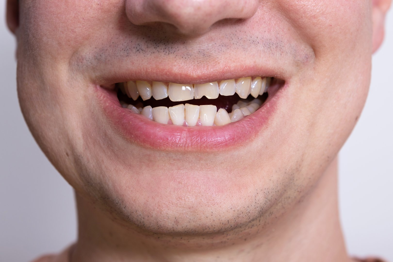 Close up of male smile with chipped damaged tooth