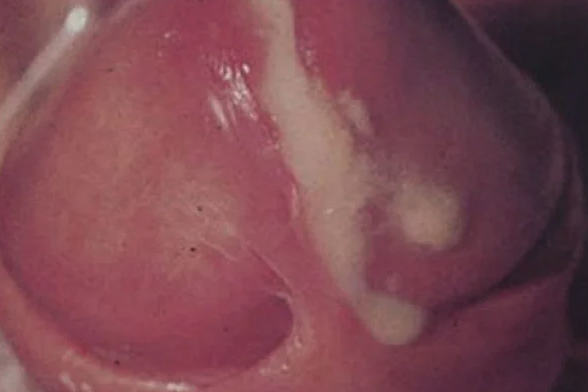 Hình ảnh minh họa bệnh lậu