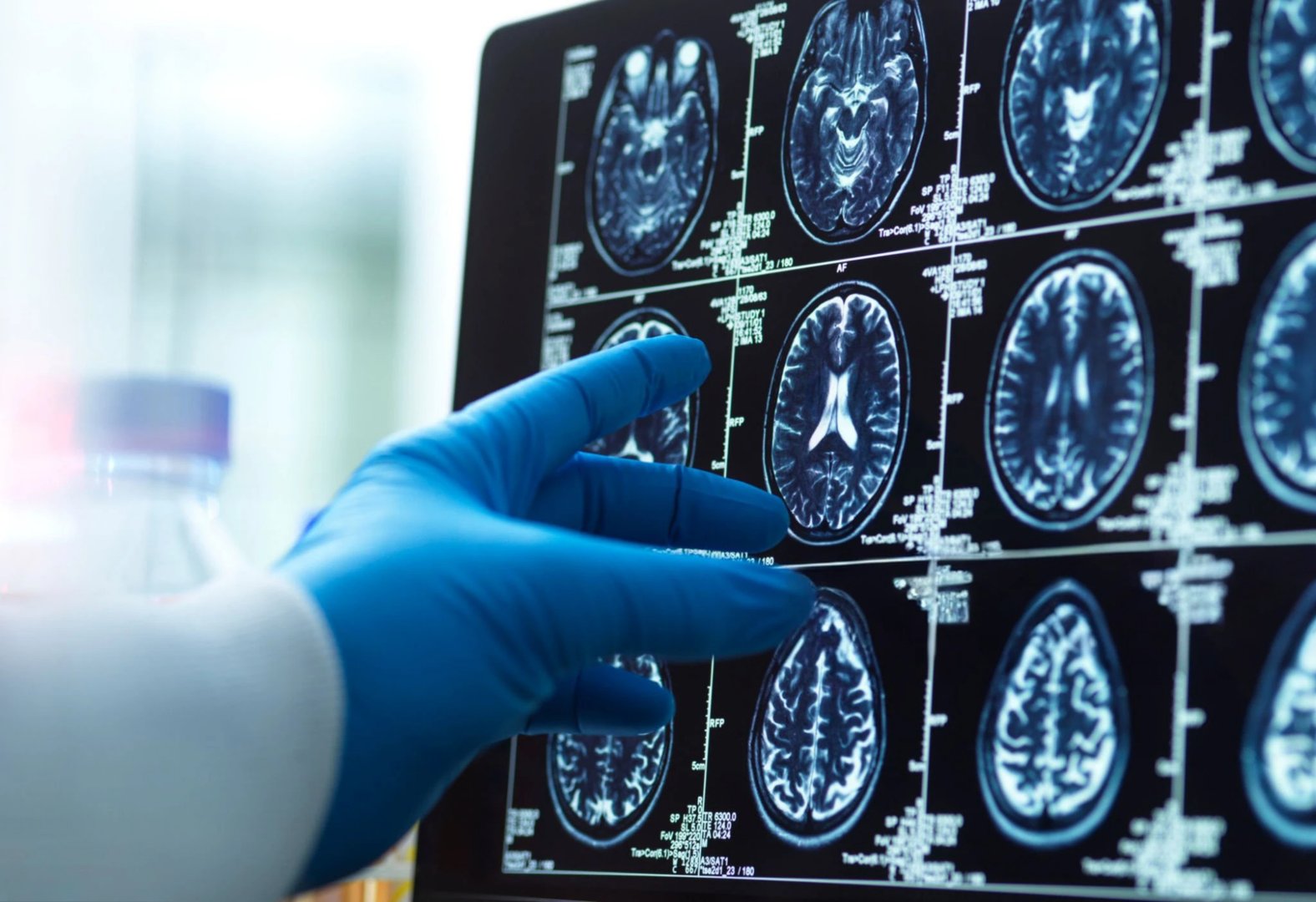 A doctor's hand in a surgical glove pointing at a brain scan image on a computer screen, diagnostic tools and medical concepts.