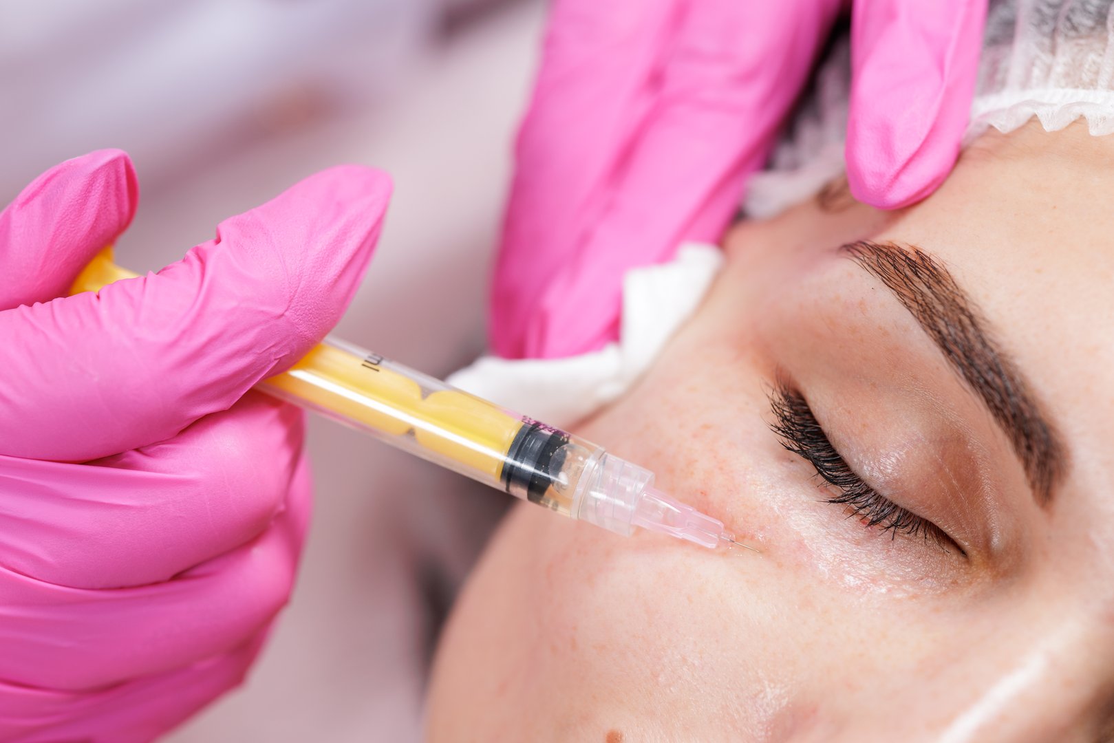 Closeup of under eye mesotherapy bioreparation injection on woman in clinic, treating wrinkles, dark circles and puffiness for rejuvenated skin.