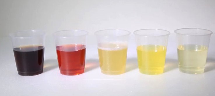 Nguyên nhân sinh lý nước tiểu màu đỏ