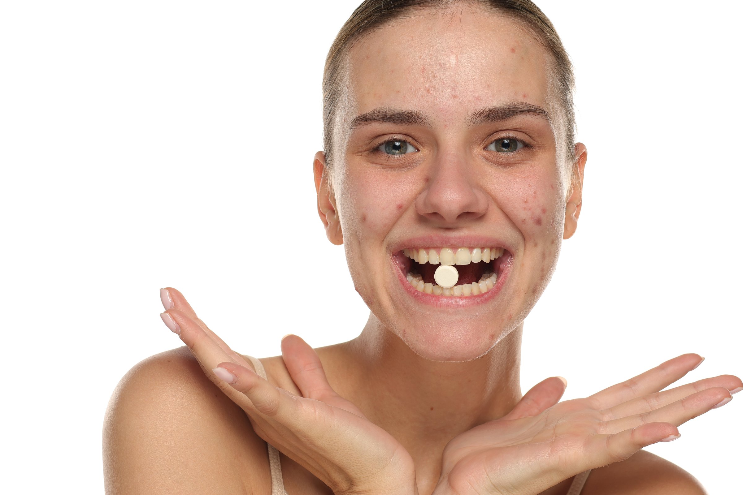 Playful woman with acne showing a pill in her mouth, studio shot on white background.