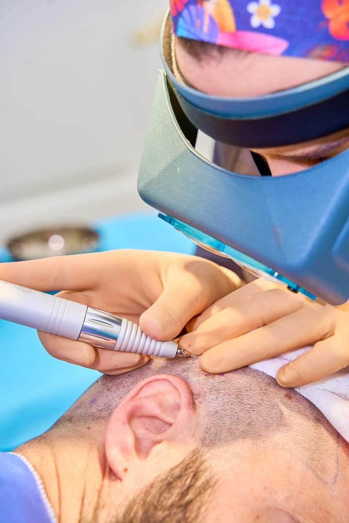 Close-up of hair follicle implantation during transplant