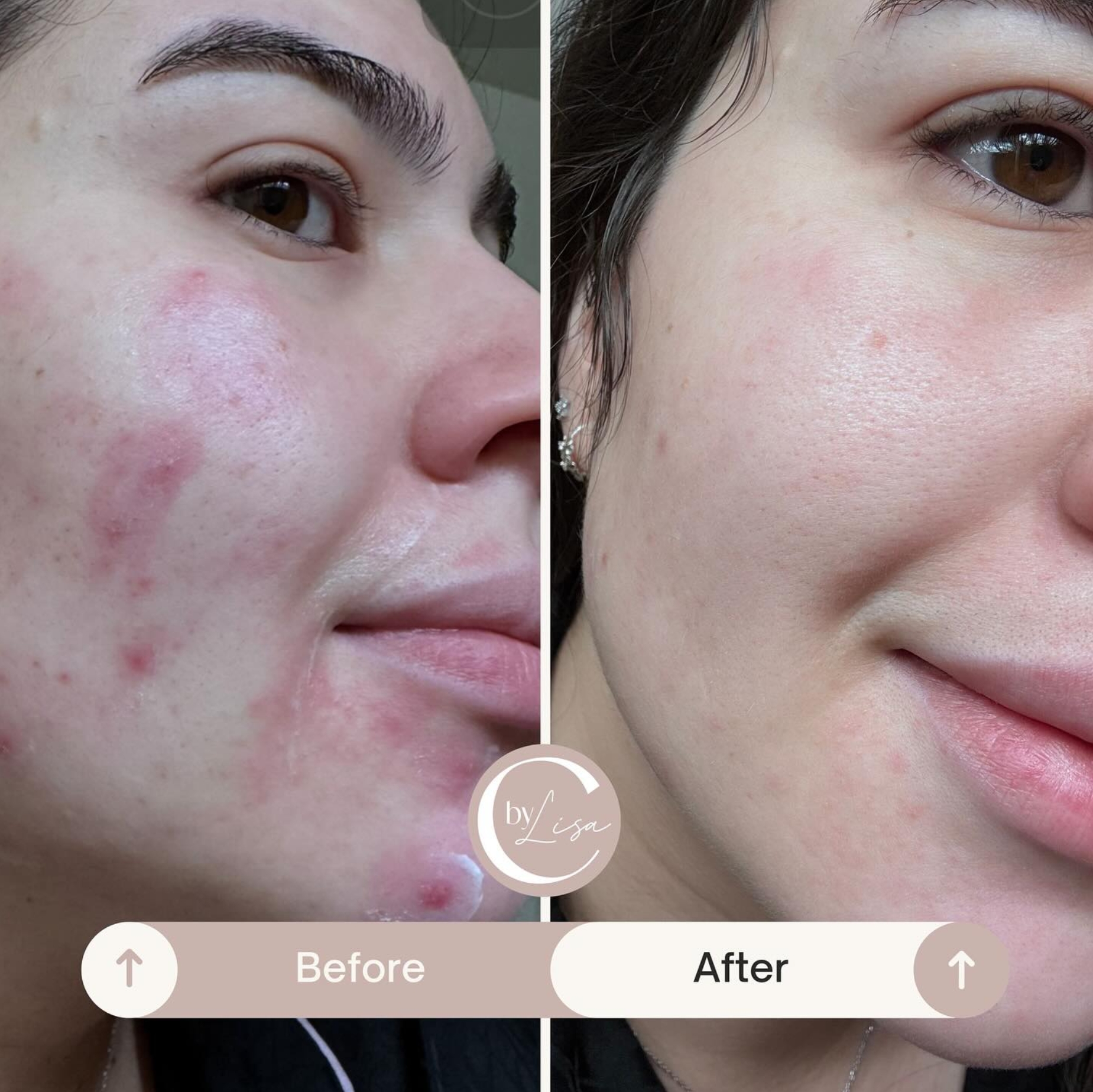 Limpieza facial profesional - Antes y después