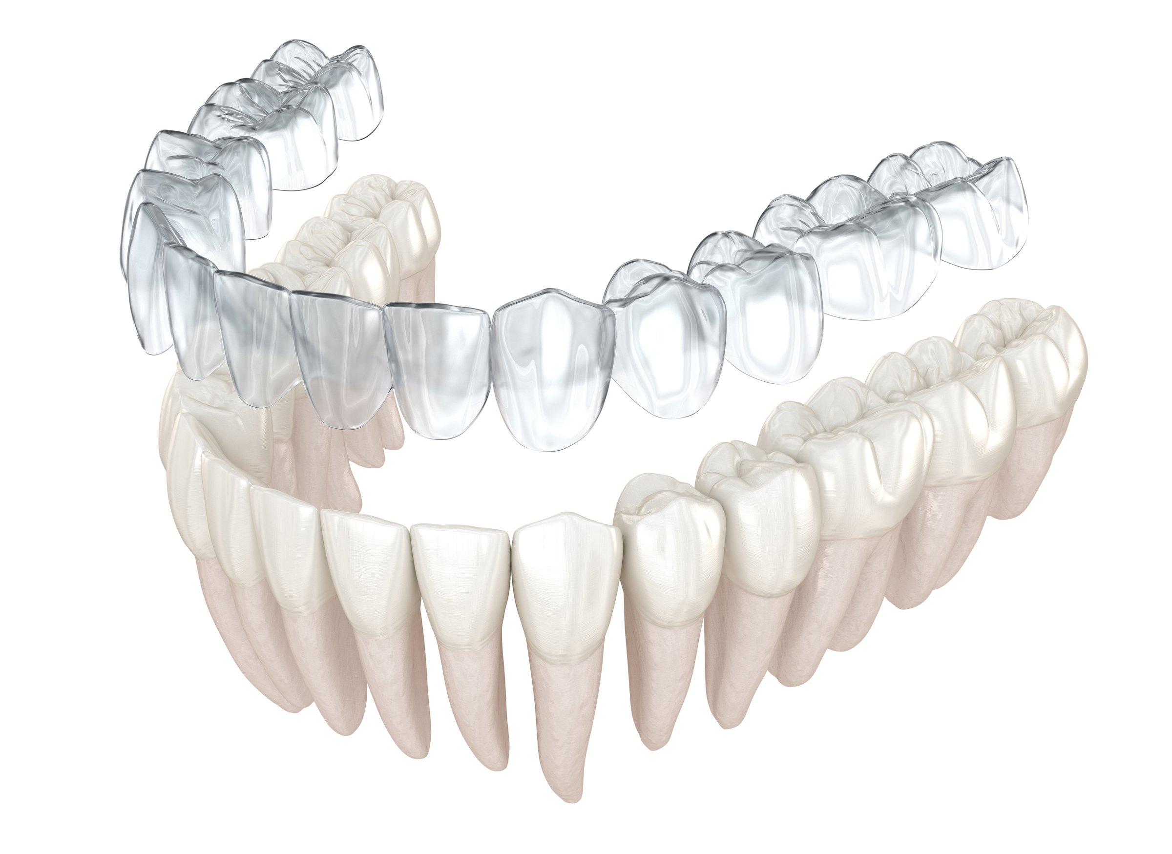 Invisalign vs Traditional Braces comparison explained by a dentist at Murwillumbah Dental