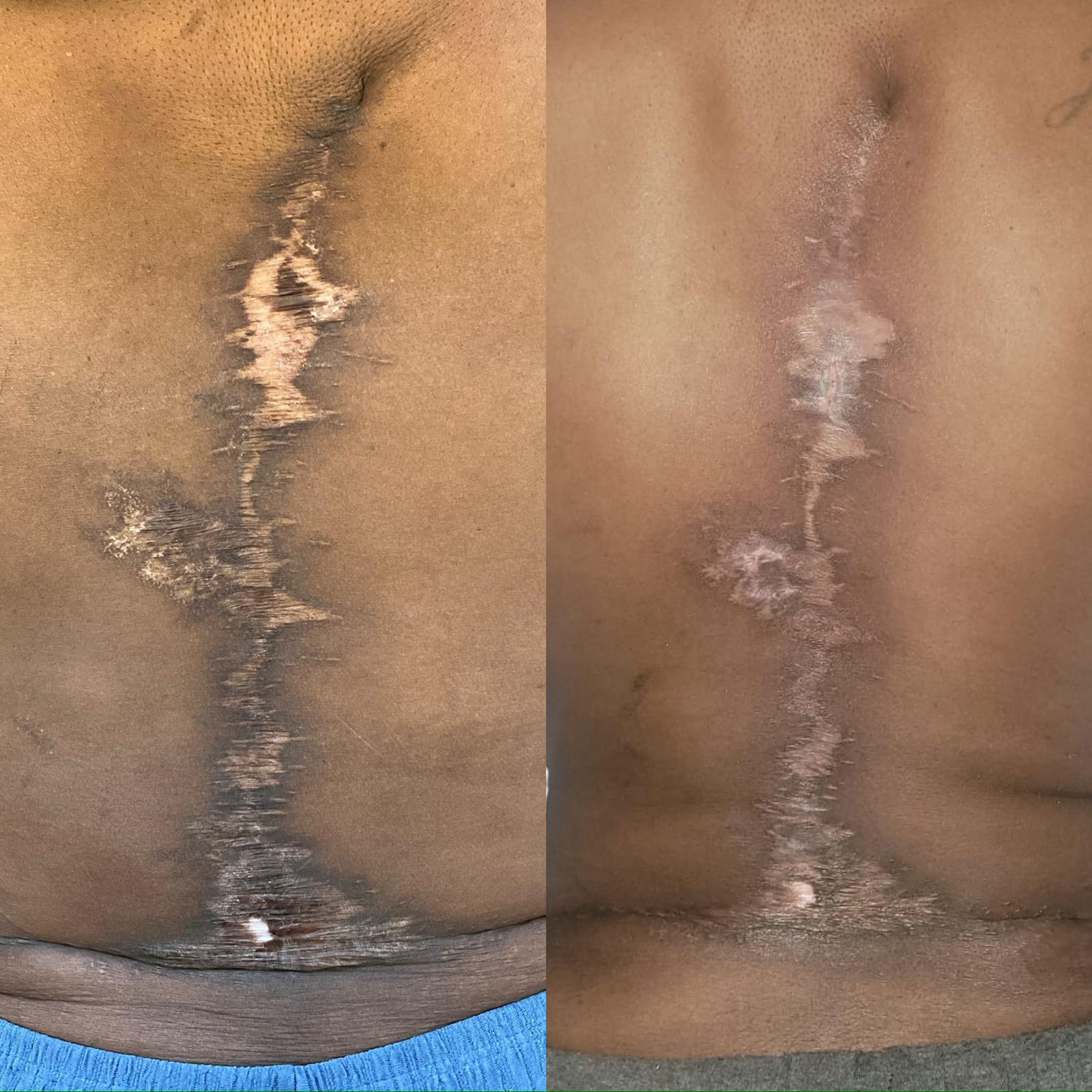 Burn scar before and after 1 session