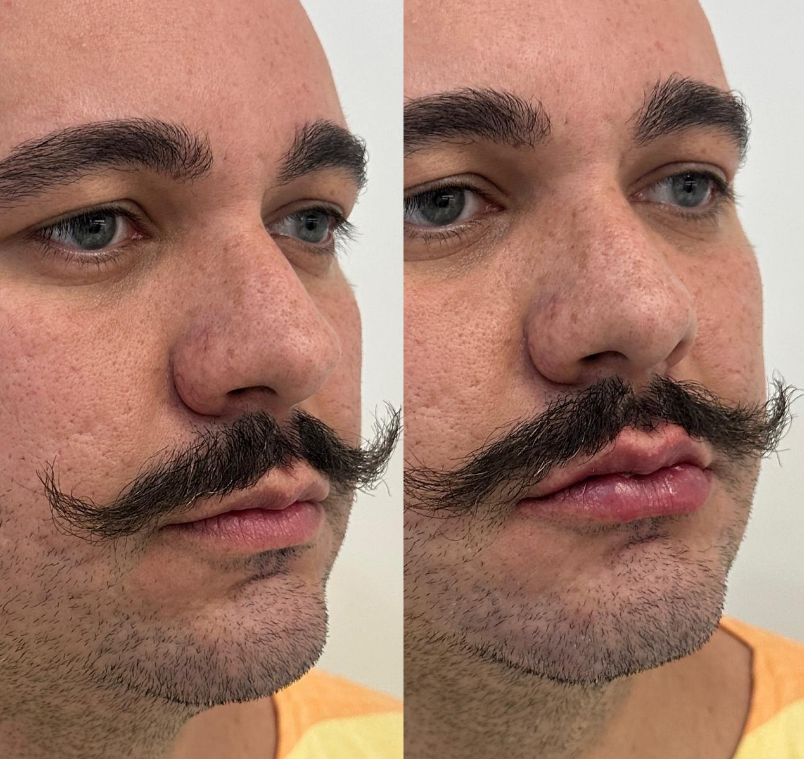 Harmonização Facial - Antes e Depois 2