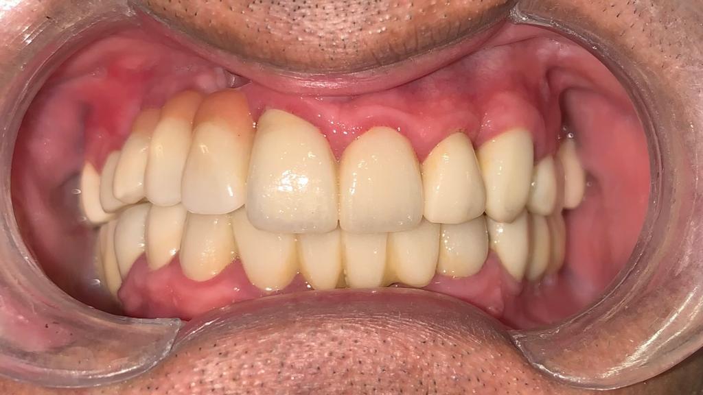 Después de tratamiento de rehabilitación oral completa