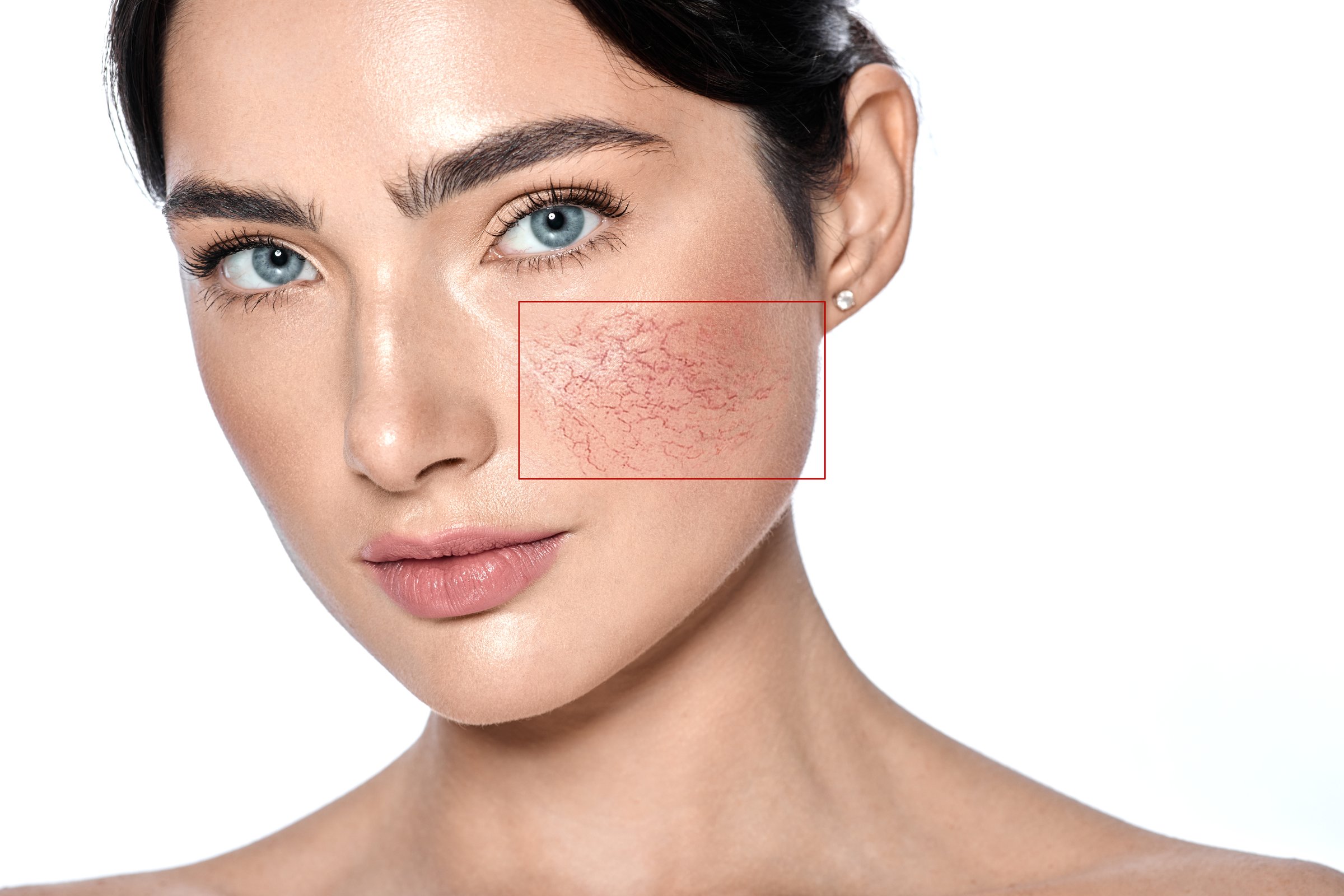 Couperose on female face skin. Woman showing problems couperose-prone sensitive skin, isolated