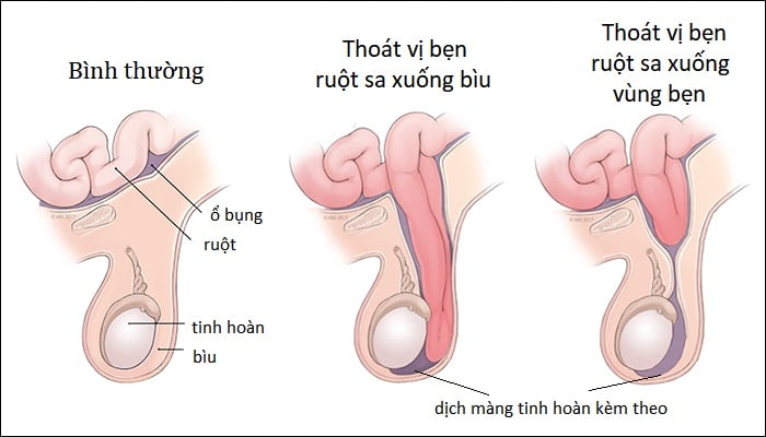Hình ảnh minh họa thoát vị bẹn ở trẻ em