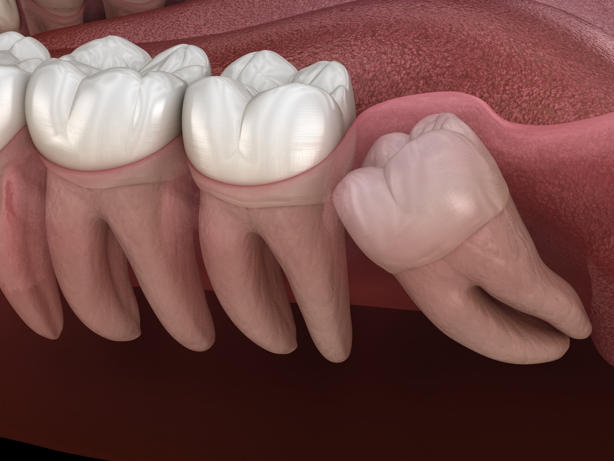 Wisdom Teeth Management