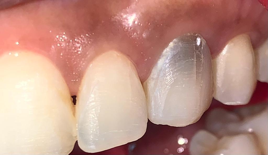 Antes de tratamiento - diente manchado post-endodoncia