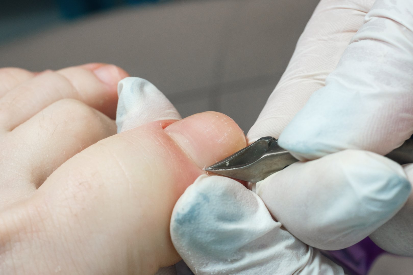 Podiatrist using pedicure clippers trims dry skin around a toenail.