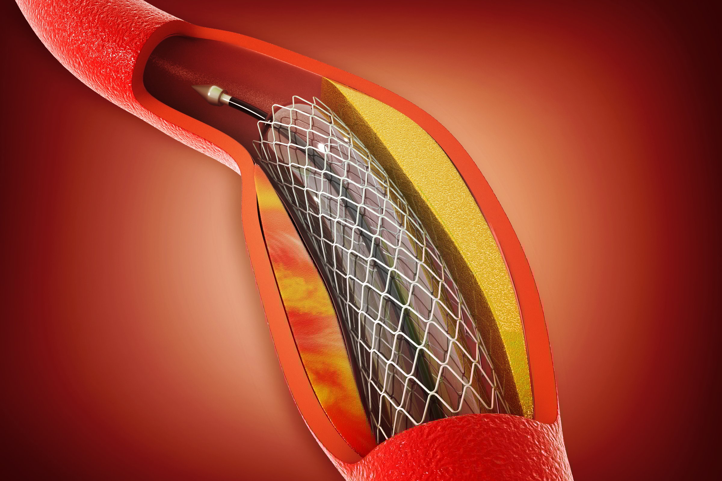 Balloon angioplasty procedure with stent in vein. 3d illustration