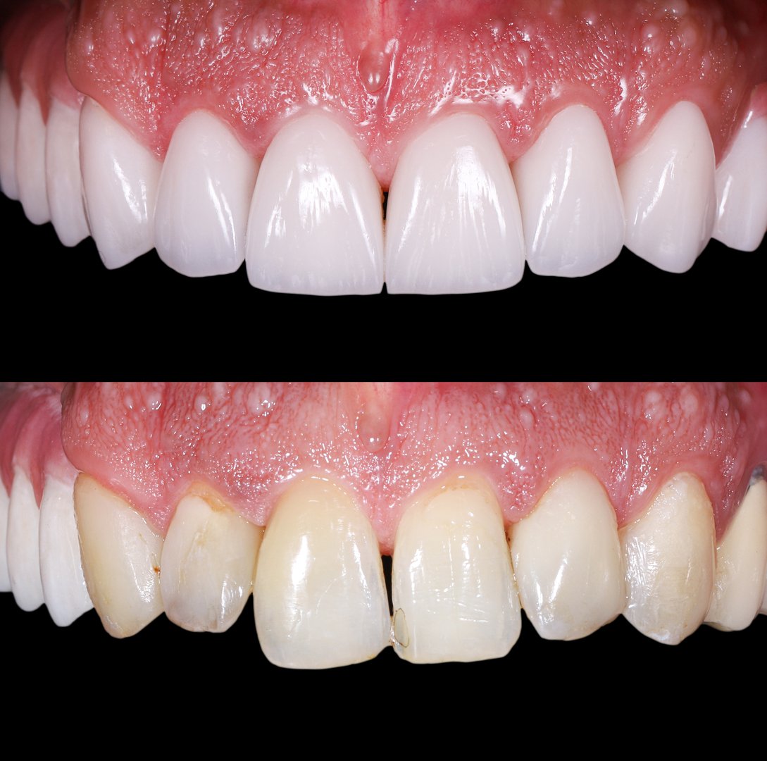 emax ceramic veneers before and after picture