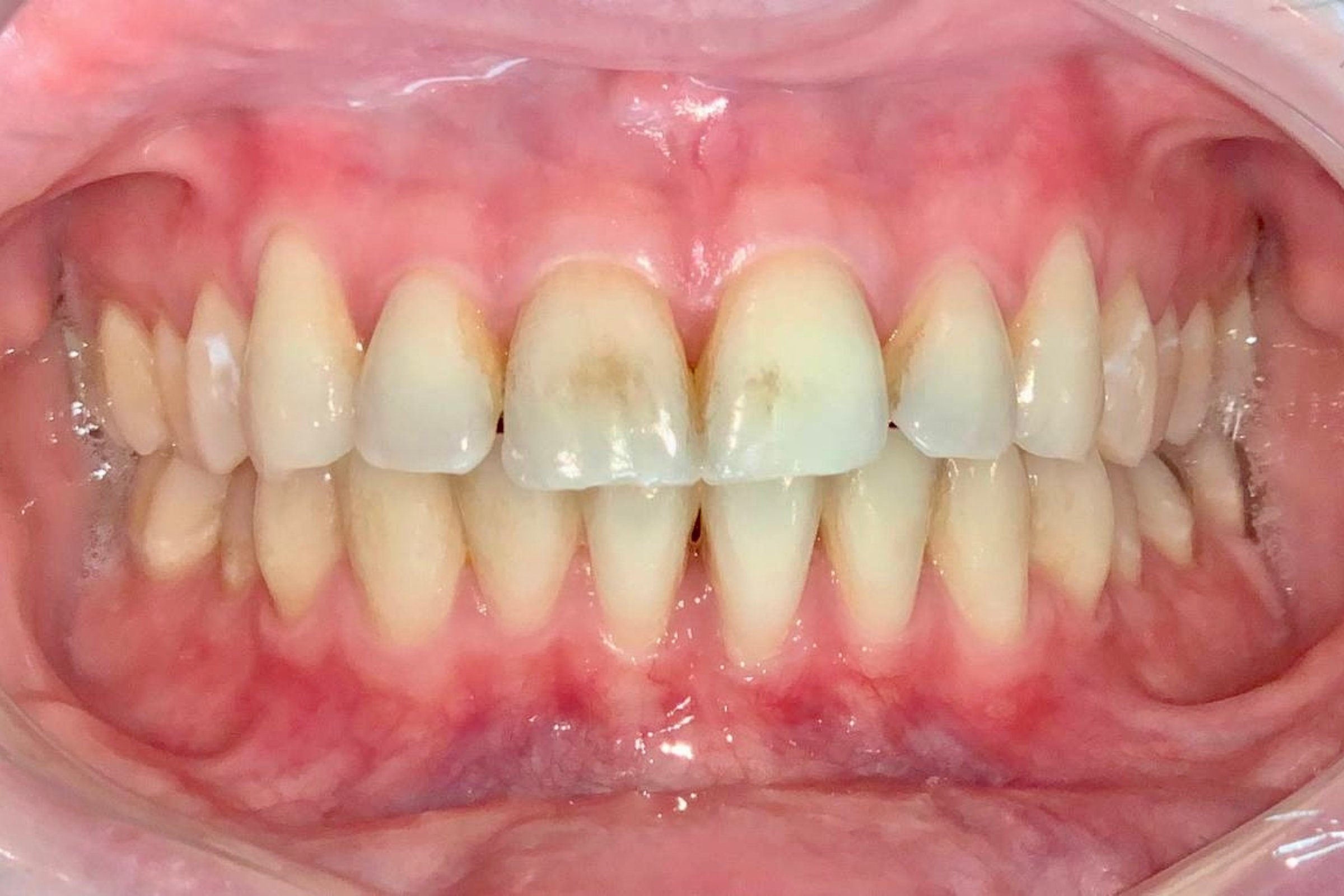 Comparativa de blanqueamiento dental