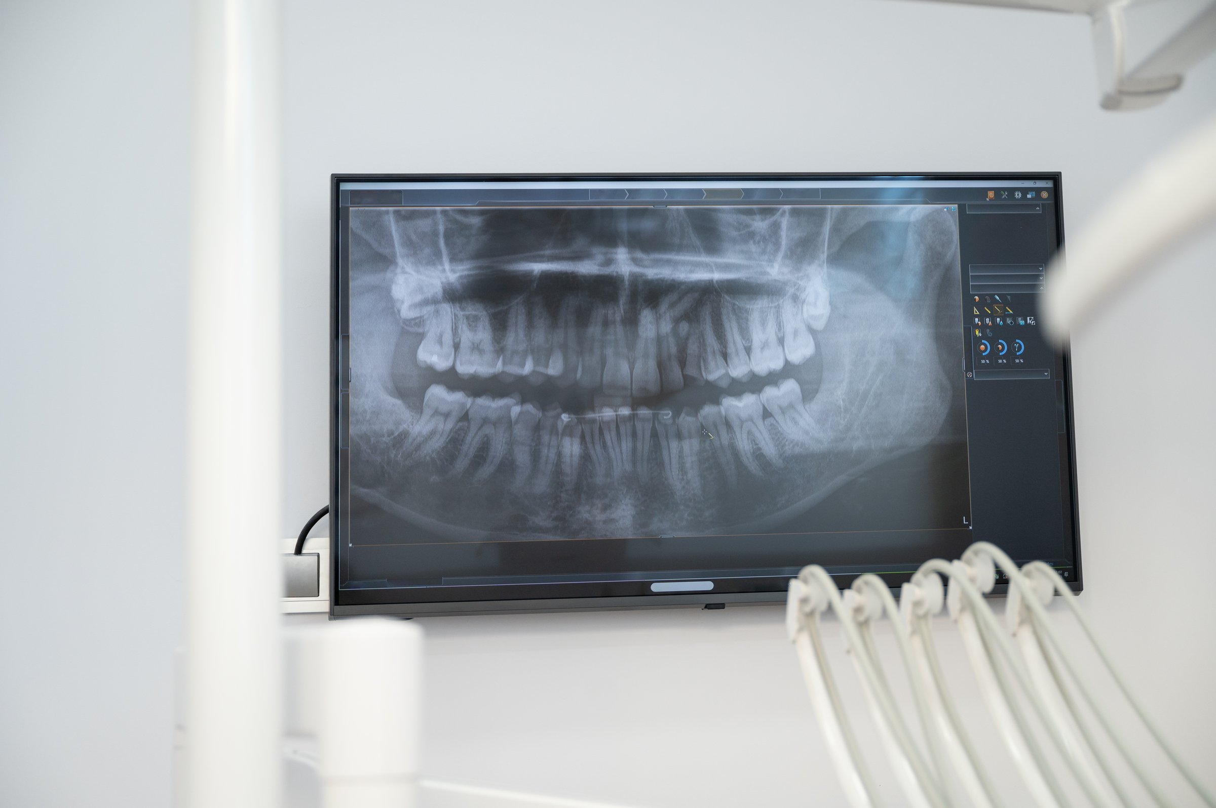 Dental panoramic radiograph showing teeth and jaw bones on a monitor in a modern dental clinic