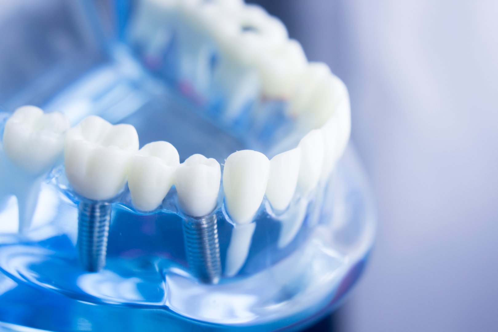 Implantes Dentales