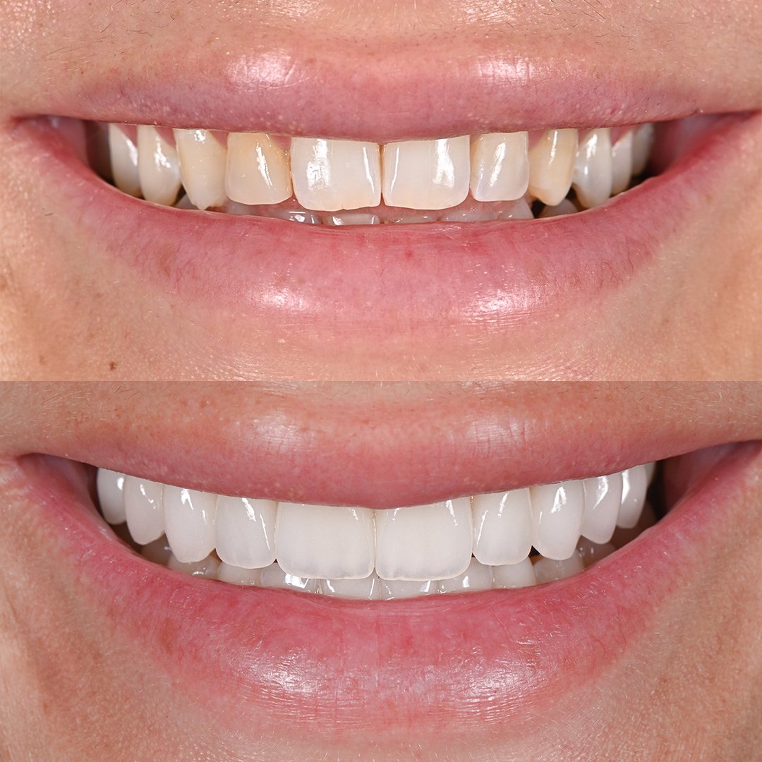 Dana B veneer transformation before and after