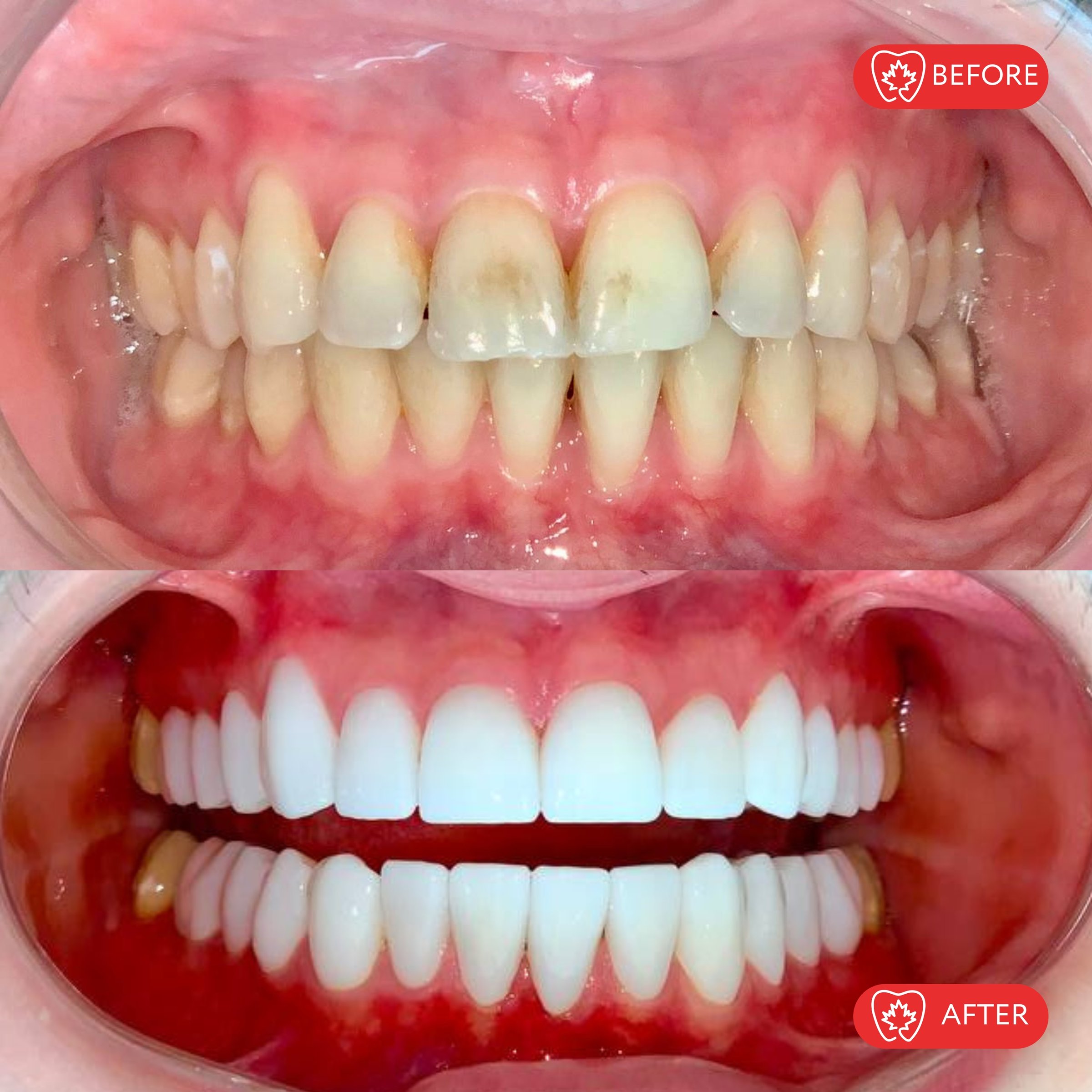 Caso de blanqueamiento dental