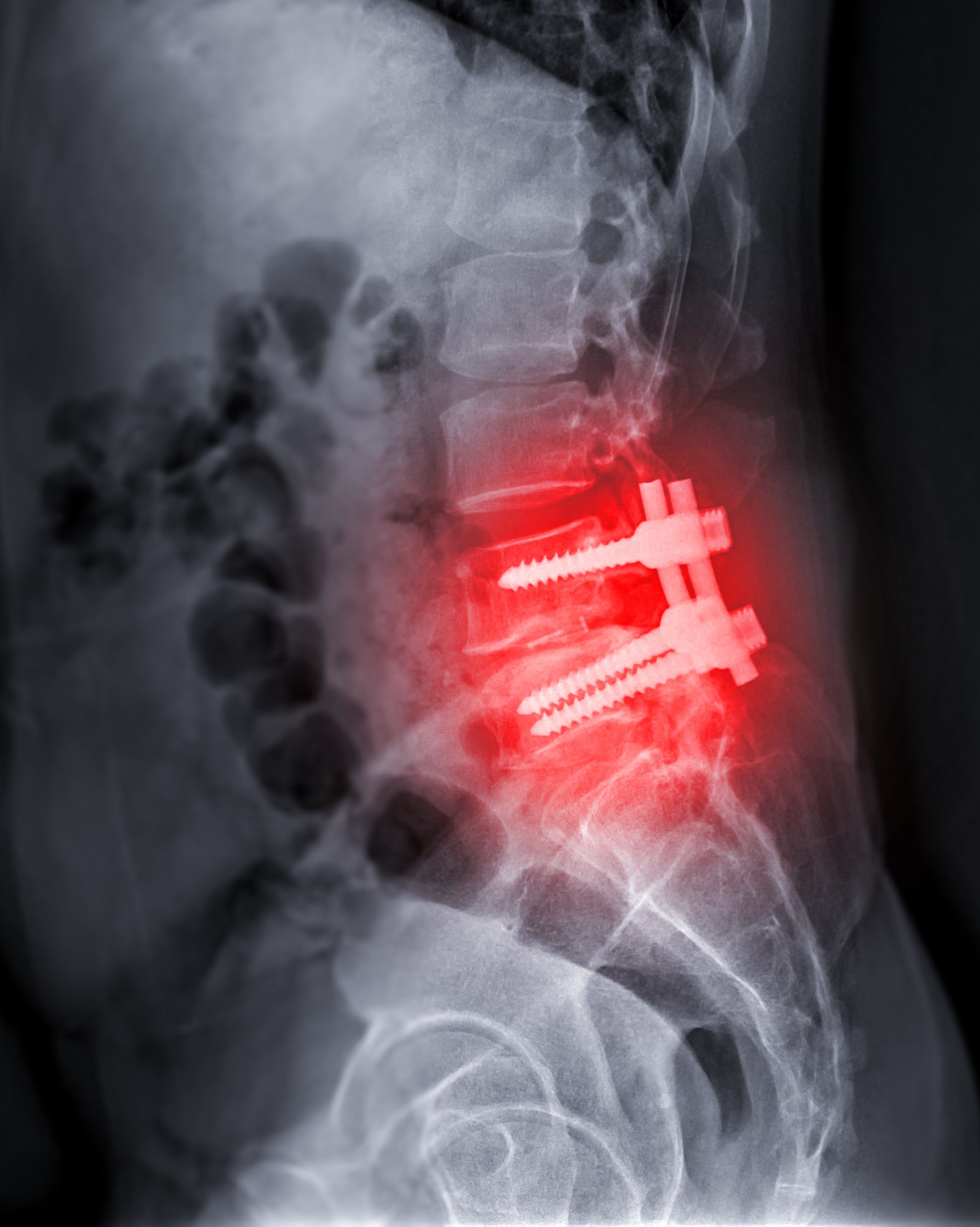 X-ray image of Lumbar spine showing pedicle screw fixation and decompression surgery in patient with spinal canal stenosis.