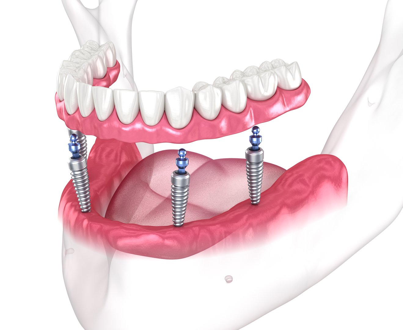 Dental prosthesis supported by implants