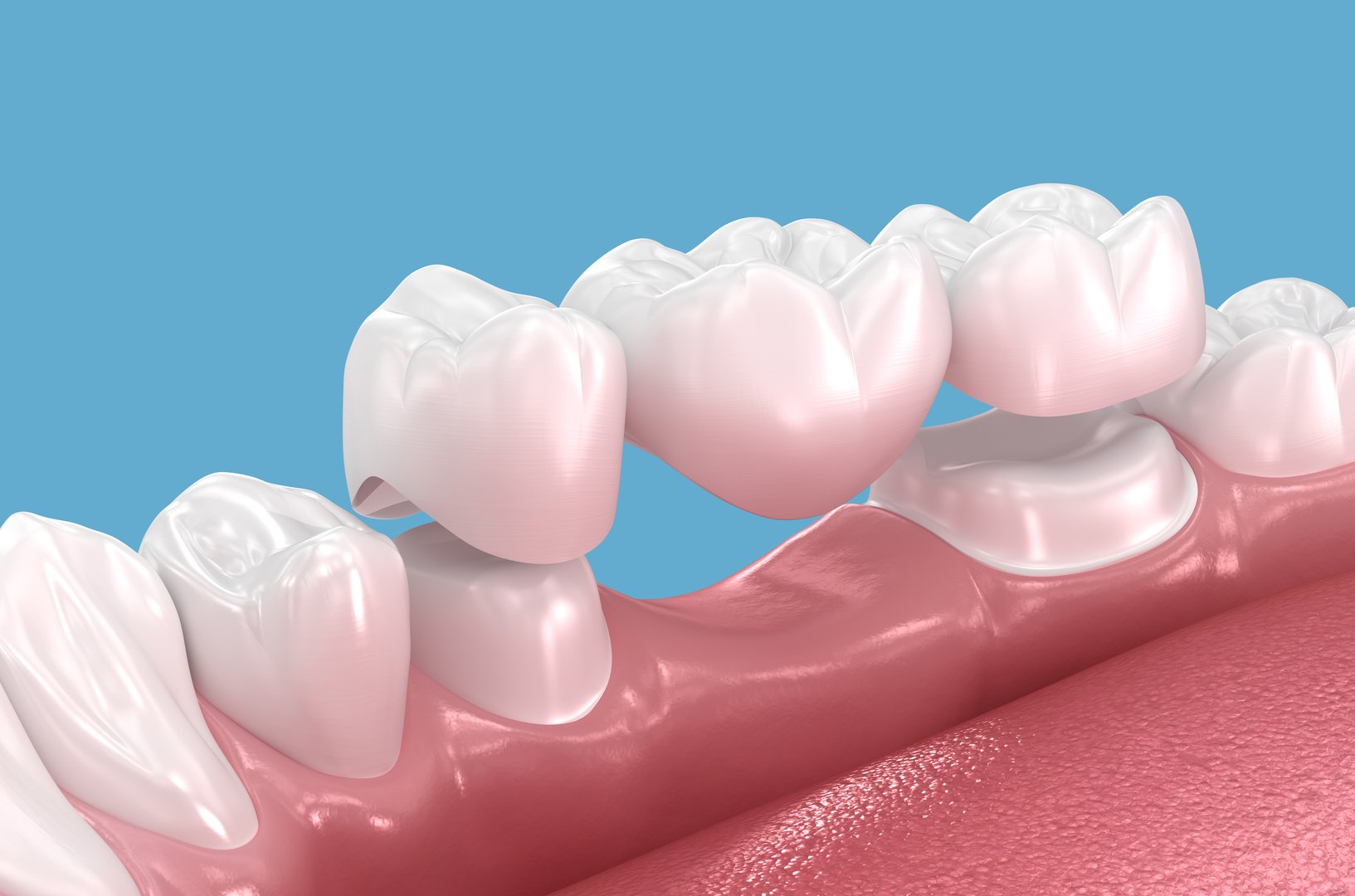 Dental bridge based on 2 teeth. Dental 3D illustration