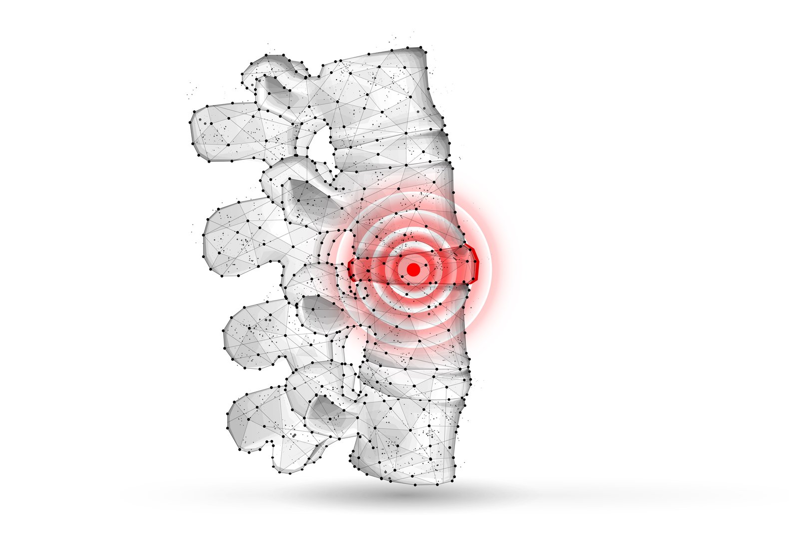 Vertebral subluxation spine illustration