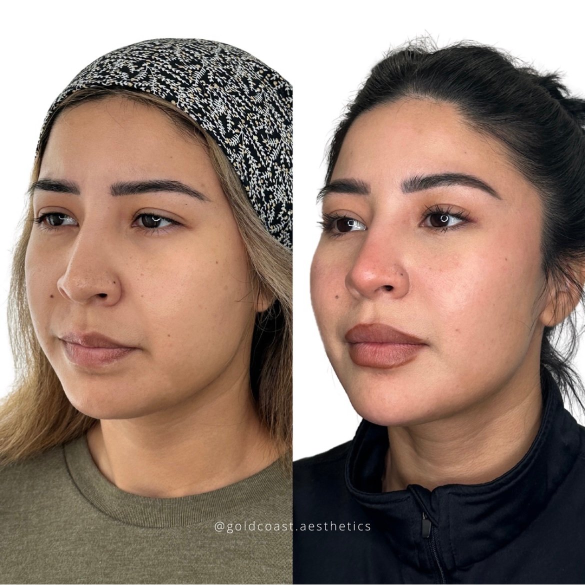 Full face transformation before and after