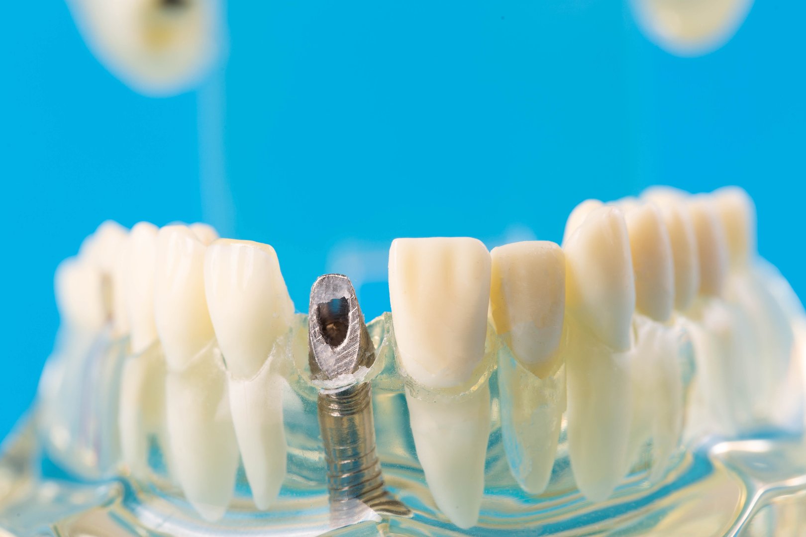 Professional dental lab work showcasing zirconia dental restorations