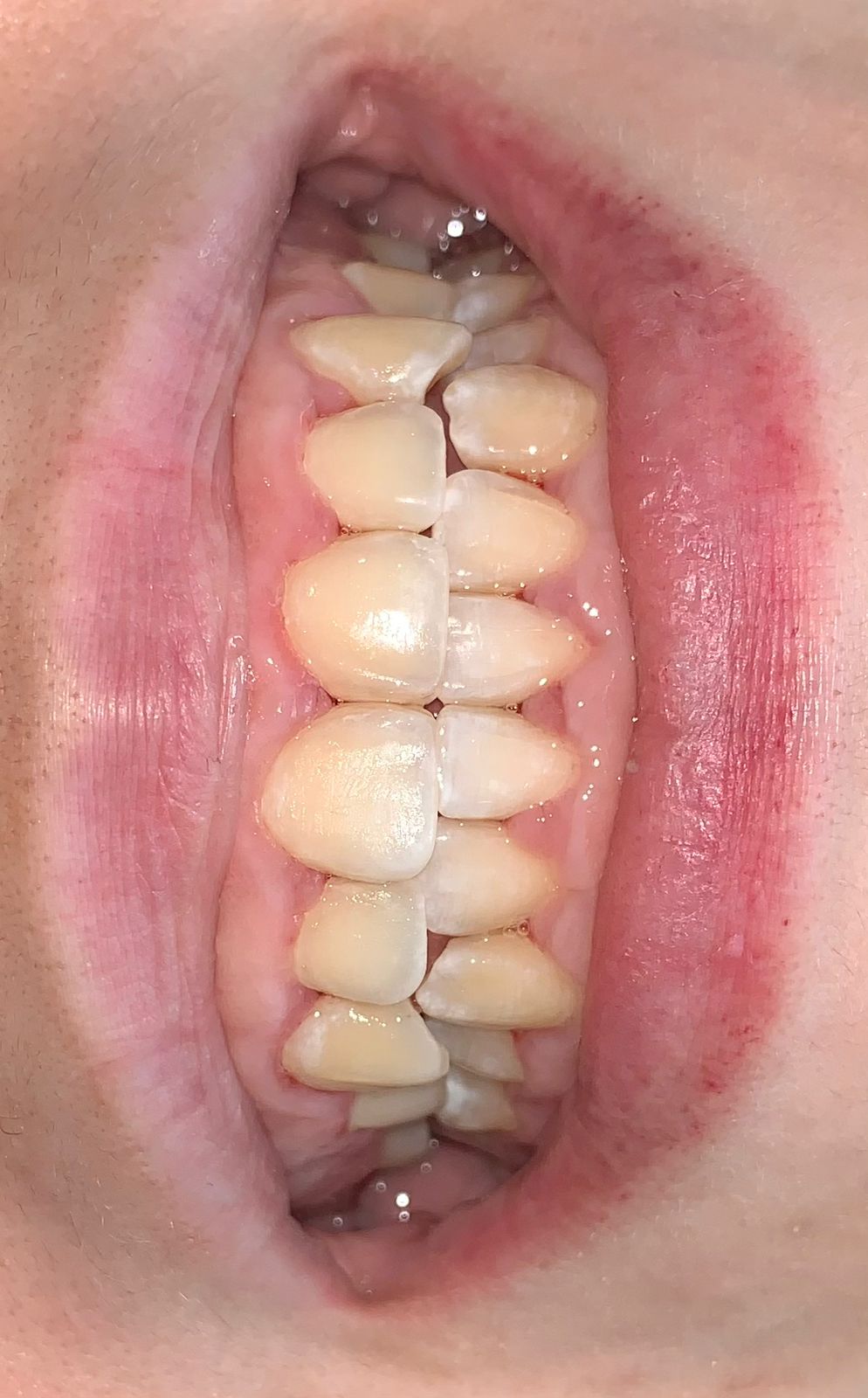 Antes del tratamiento - Caso 2