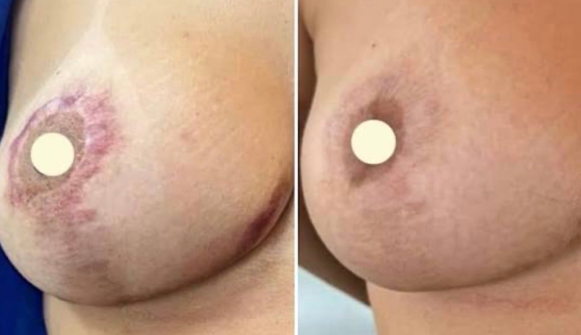 Before and after breast restoration scar camouflage result