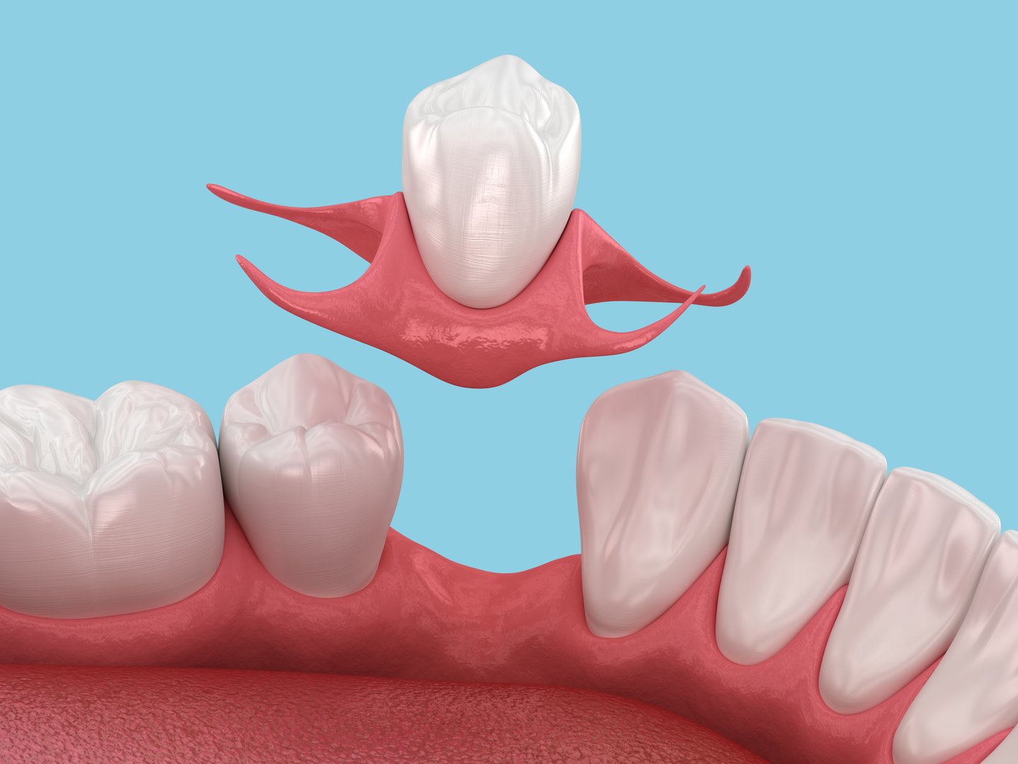 Partial removable immediate-denture type Butterfly. Replacement of one missing tooth 3D illustration
