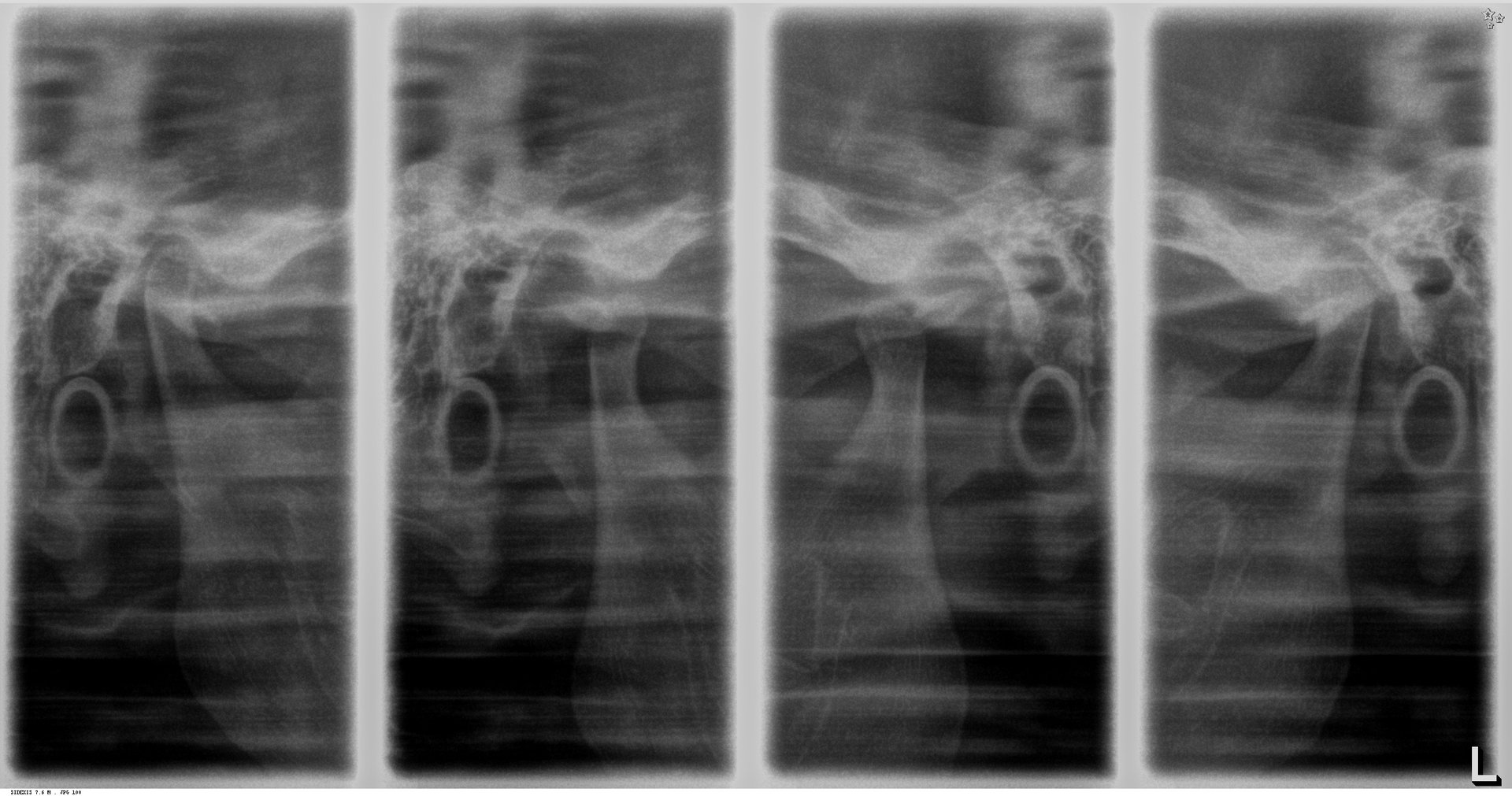 Fluoración Dental