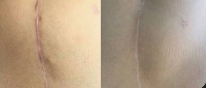 Before and after breast restoration scar camouflage result
