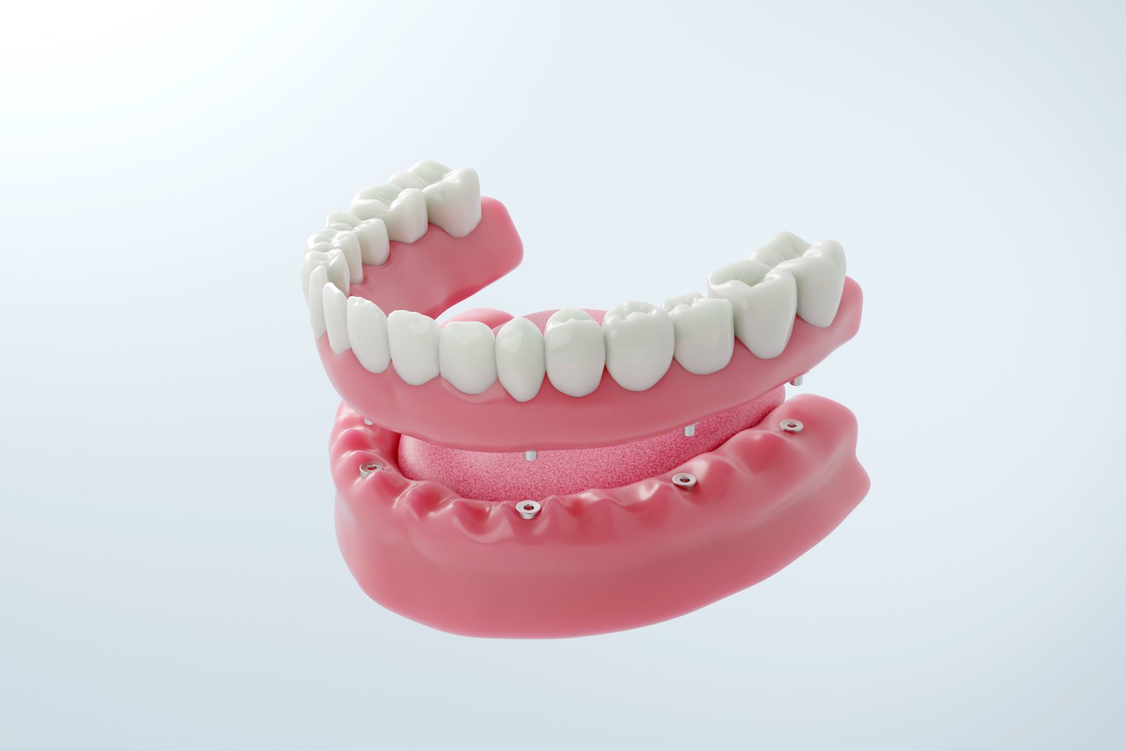 Full jaw dental implant procedure showing a complete prosthetic bridge for total mouth reconstruction and tooth replacement. 3D render.