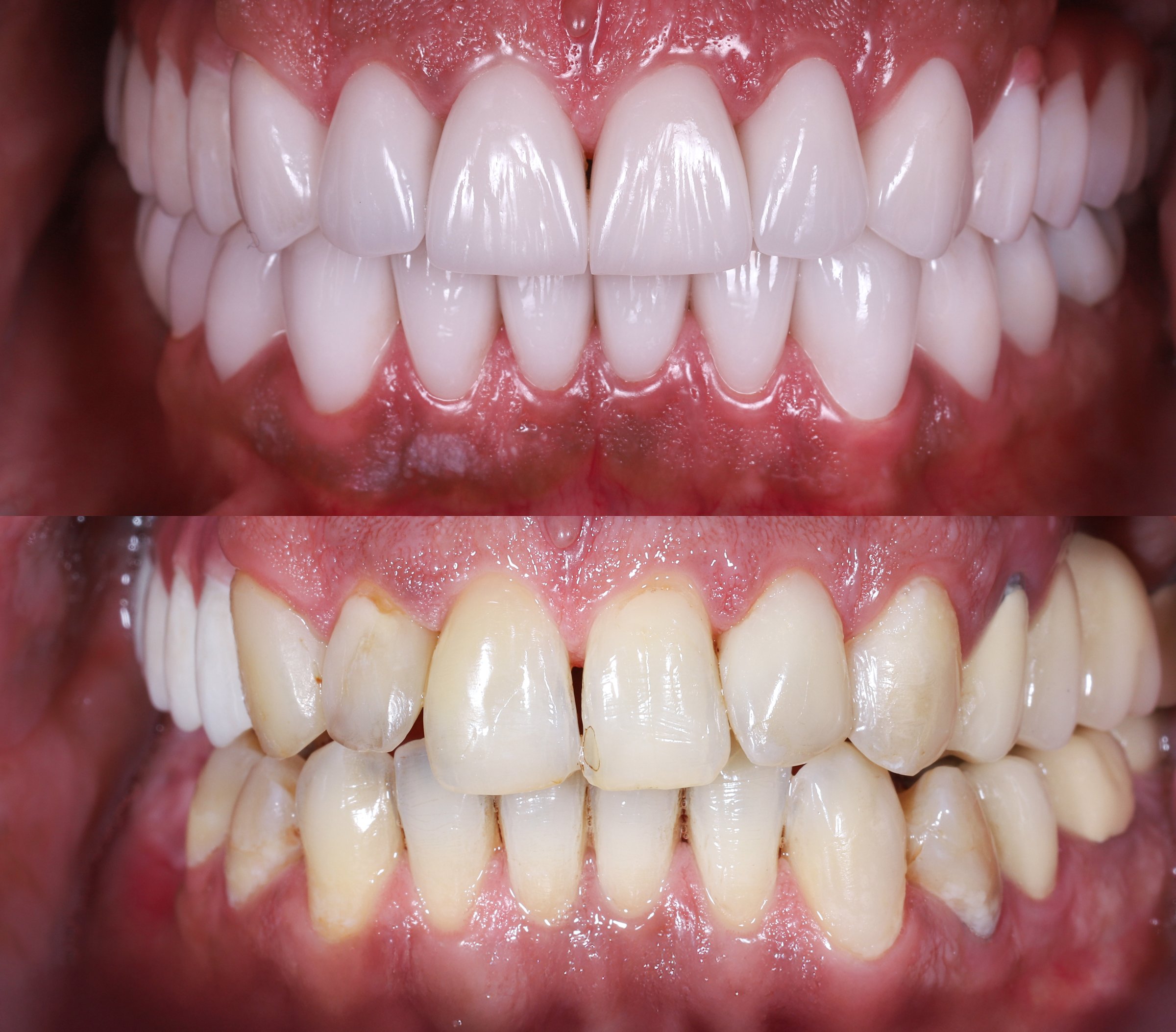 emax ceramic veneers before and after picture