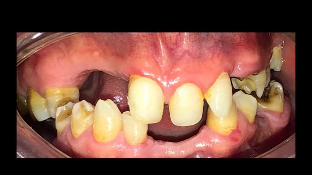 Antes de tratamiento de rehabilitación oral completa - ausencia dental múltiple