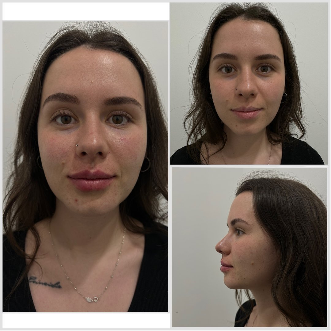 Antes y después - Relleno de labios