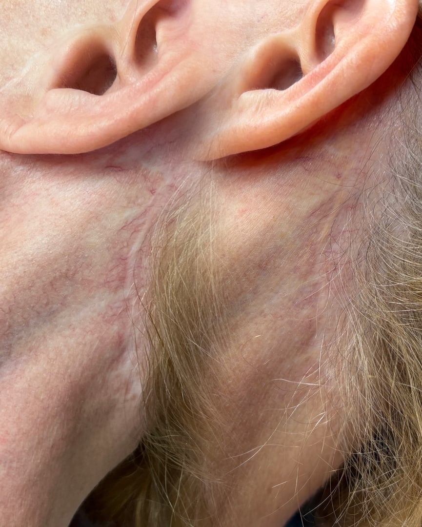 Facelift scar camouflage before and after transformation